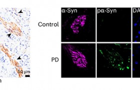新研究发现帕金森病不是源自大脑，而是肾脏